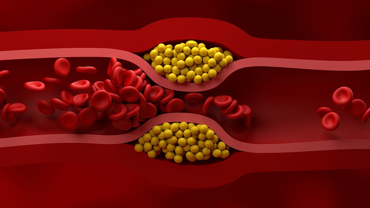 US Cardiologists Have Just Published New Guidelines For Managing Cholesterol : ScienceAlert