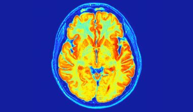 Scientists Have Found a New Neurodevelopmental Disorder Hidden in Our Genes : ScienceAlert