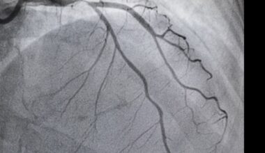Novel algorithm improves detection of moderate-to-severe aortic stenosis