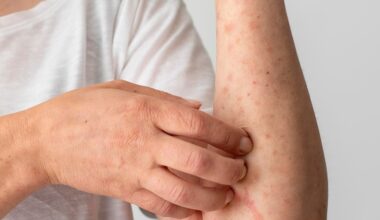 Health officials warn of possible measles exposure in Colorado Springs