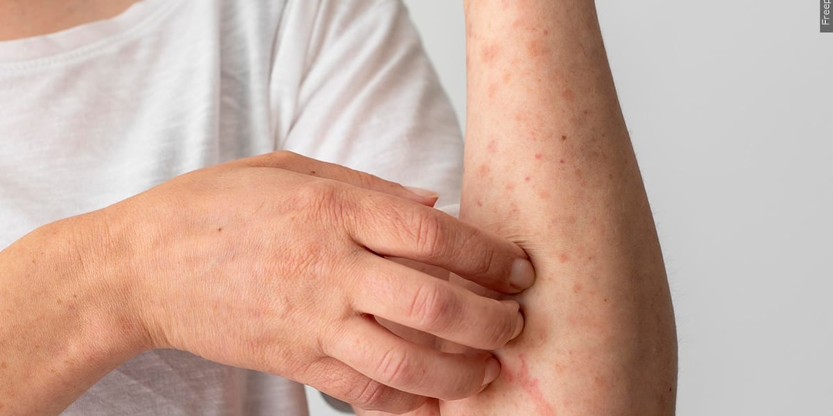 Health officials warn of possible measles exposure in Colorado Springs