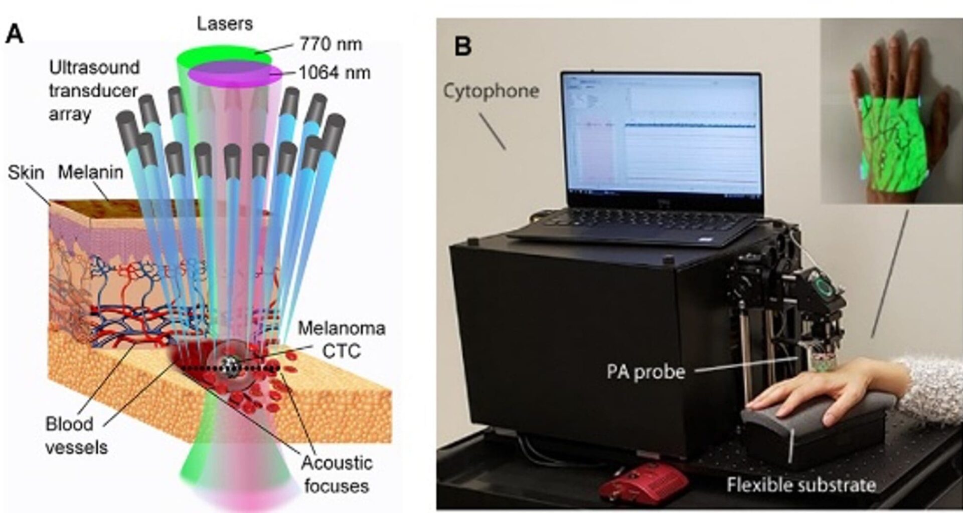 Earliest deadly disease diagnosis and treatment with cytophone