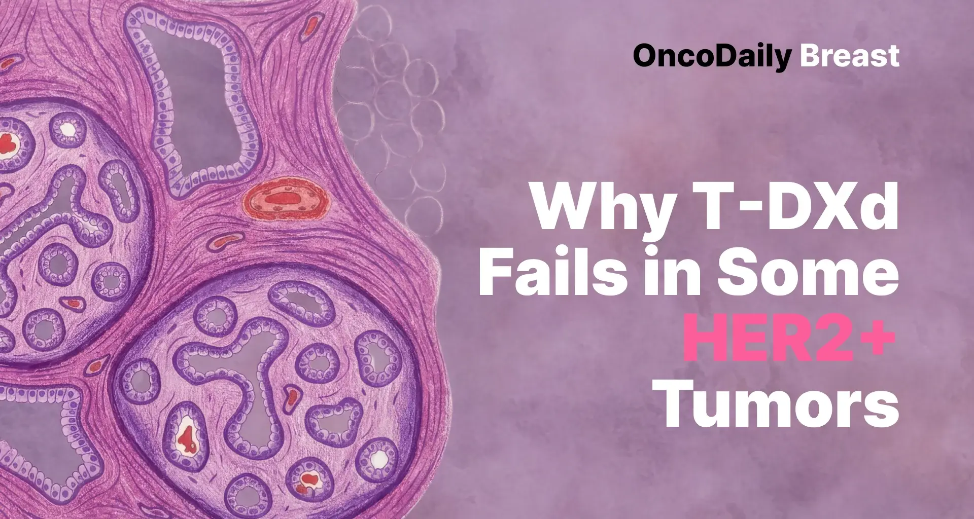 HER2 Heterogeneity in Breast Cancer May Explain Why Some Tumors Escape T-DXd