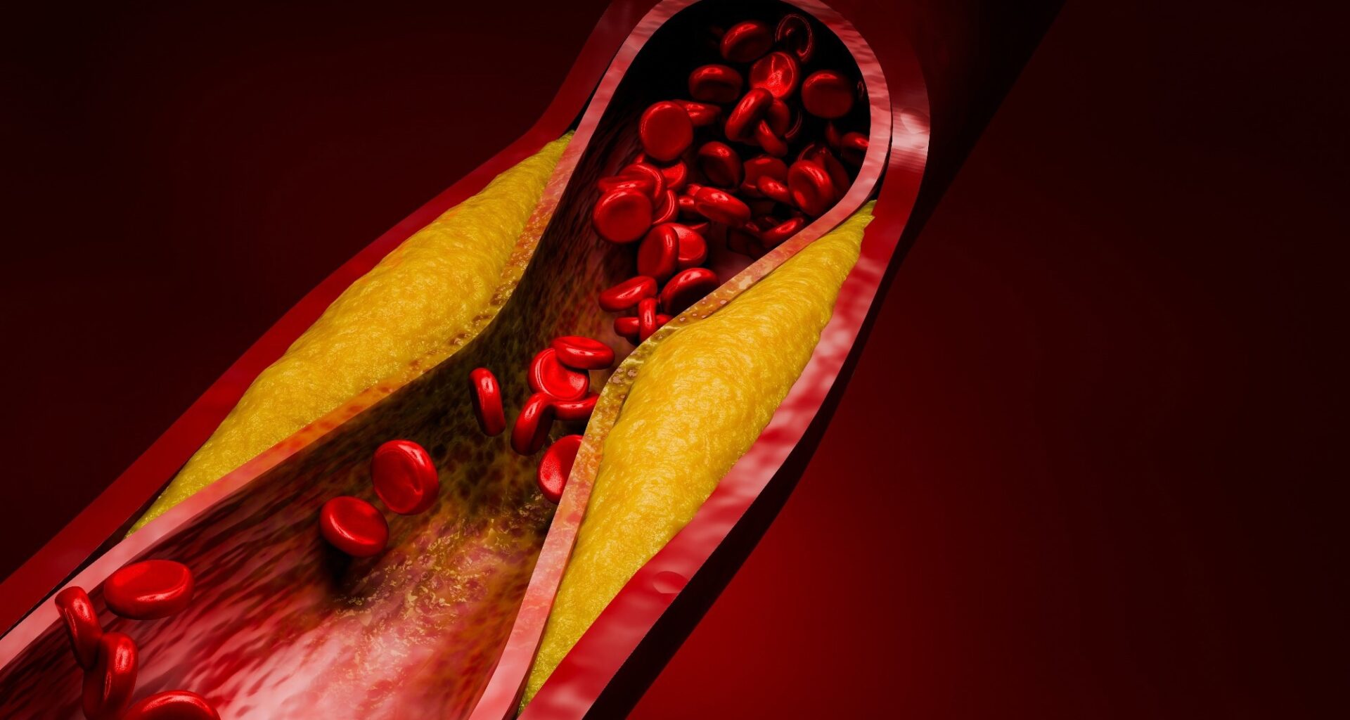 Evolocumab trial could reshape how doctors treat high-risk cholesterol patients