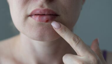 The woman with a virus herpes on lips