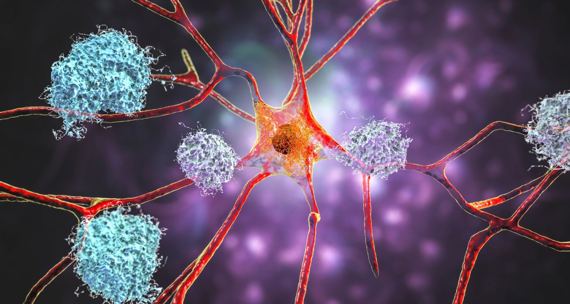 Neurons in Alzheimer