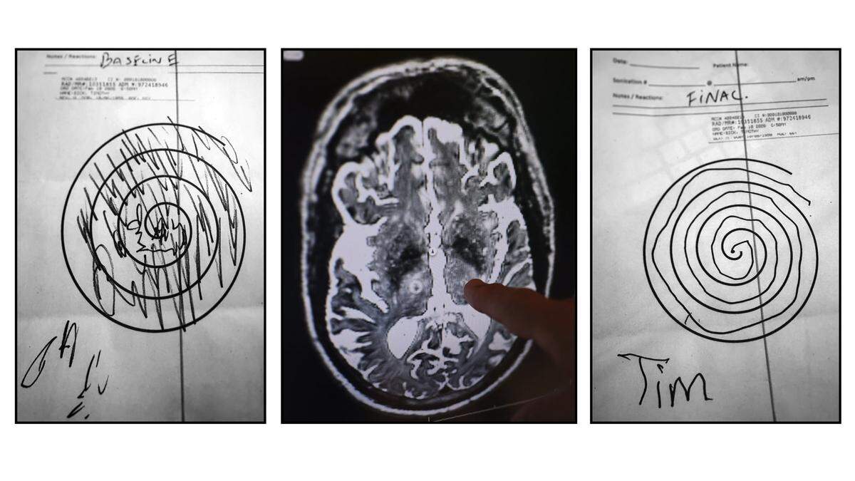 Timothy Sick, 66, shares pre-treatment test, left, his brain scan, and post-treatment test, right, results from a treatment for Parkinson's disease symptoms on Tuesday, April 28, 2026, in Fort Lauderdale. The test shows improvement in Timothy's motor skills.