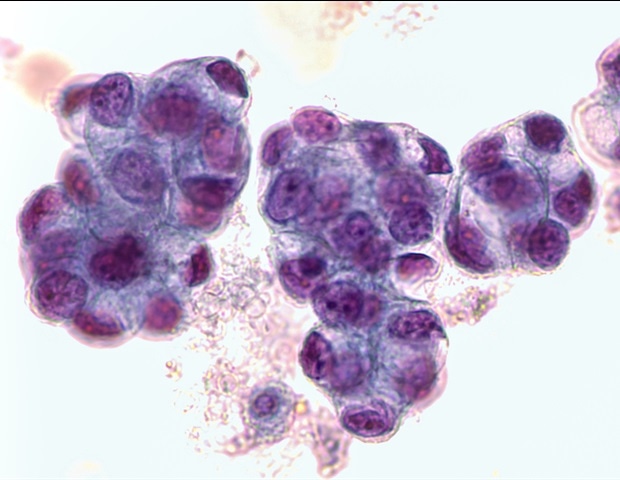 Clusterin inhibition offers new hope for treating cervical gastric-type adenocarcinoma