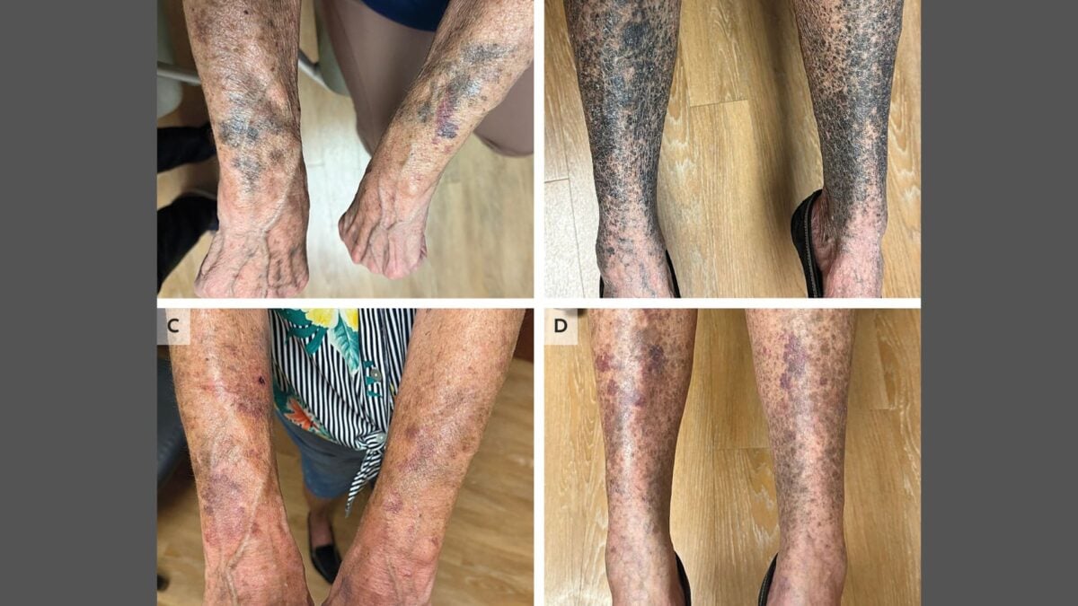 Antibiotics Turned This Woman’s Limbs Into an Unsettling Horrorshow