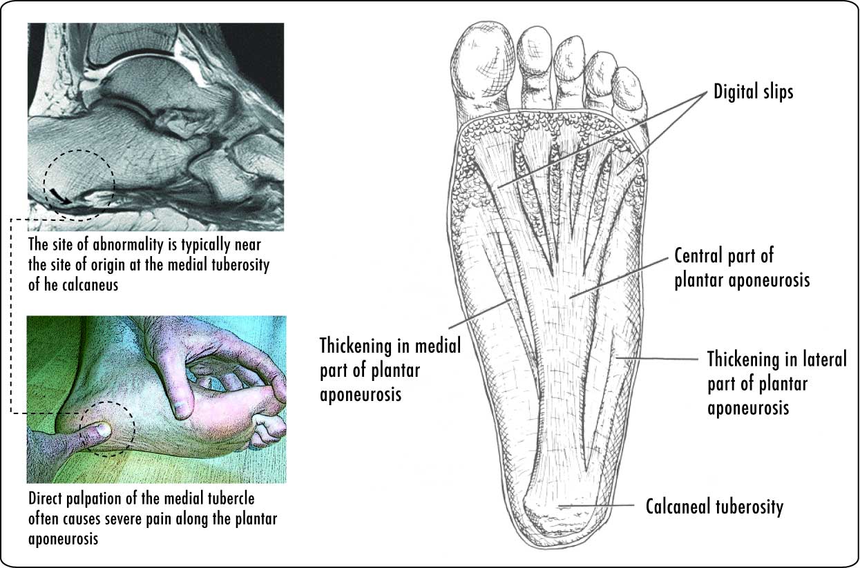 diagram of plantar fascia
