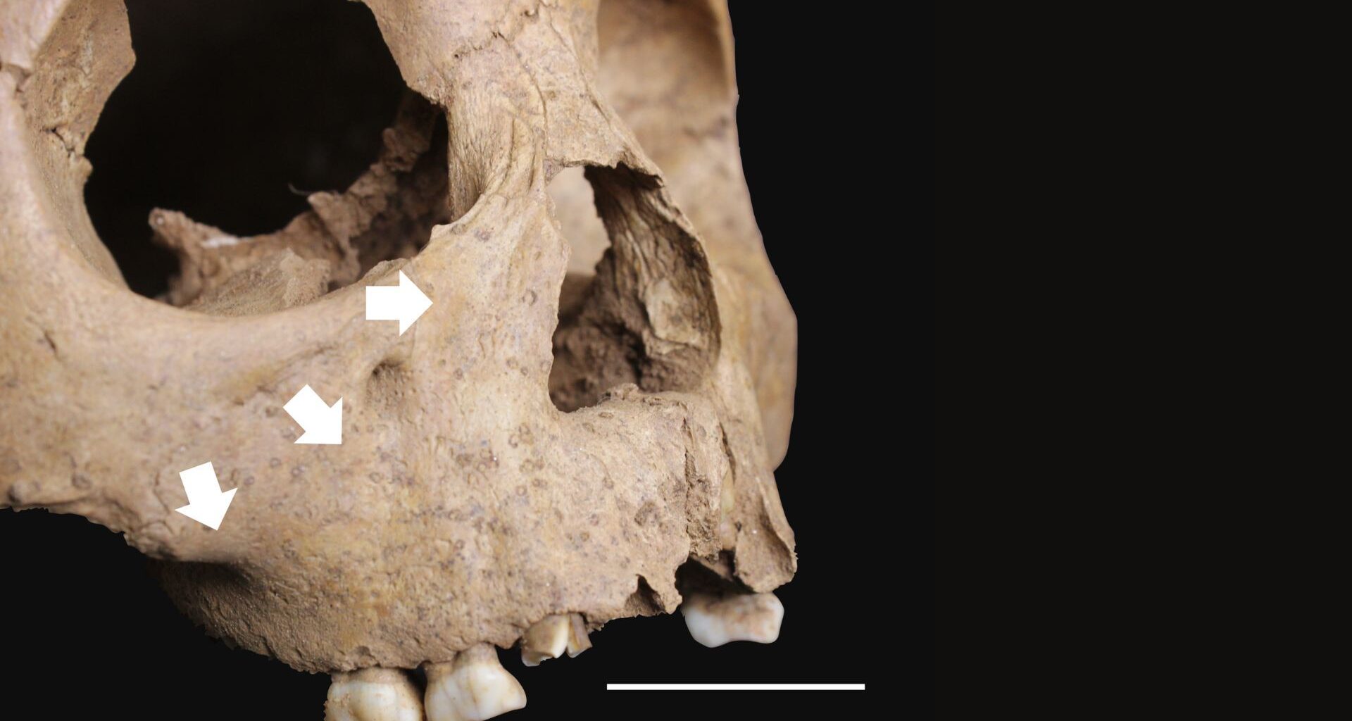 A close up of a skull with white arrows pointing to various areas on its bony cheeks with a dark background behind