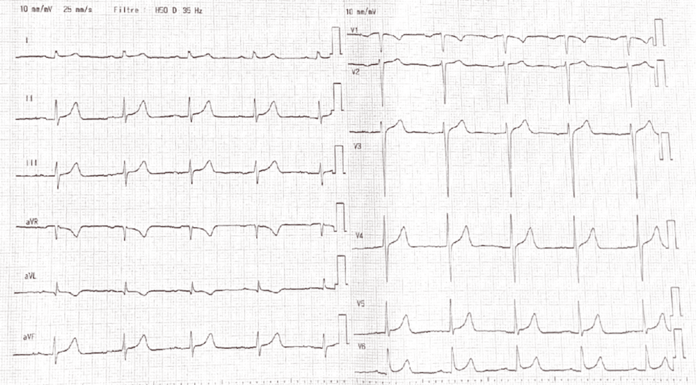 Obstructive Hypertrophic Cardiomyopathy and Interarterial Anomalous Aortic Origin of the Right Coronary Artery (AAORCA) Presenting With Syncope: Multimodal Diagnostic Assessment and Individualized Management
