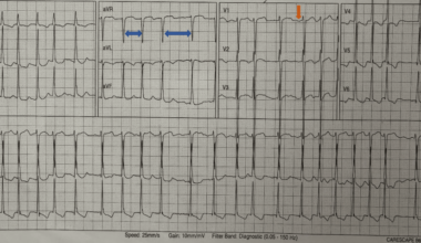 First Documented Atrial Fibrillation Triggered by Dialysis-Induced Autonomic Instability in End-Stage Kidney Disease