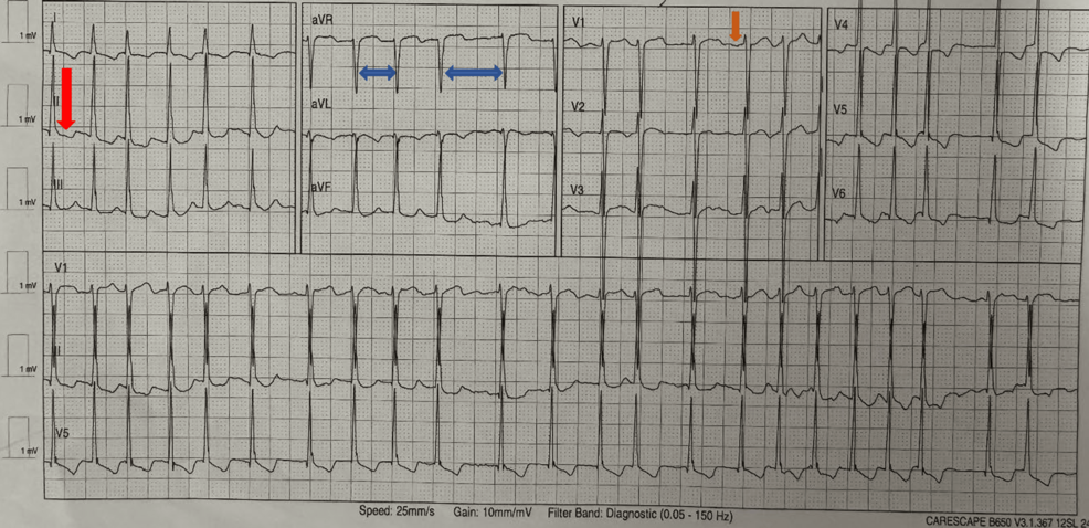 First Documented Atrial Fibrillation Triggered by Dialysis-Induced Autonomic Instability in End-Stage Kidney Disease