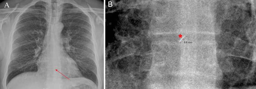 Pneumatic Nail Gun Injury to the Cardiac Box: A Case Report of Successful Extraction of a Potentially Dangerous Tool