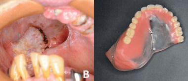 A Customized Radiation Carrier for Recurrent Maxillary Cancer: A Clinical Report