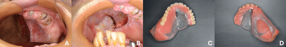 A Customized Radiation Carrier for Recurrent Maxillary Cancer: A Clinical Report