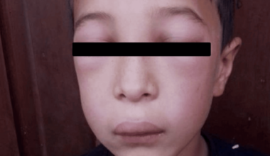 Multidimensional Assessment of Laryngeal Risk and Quality-of-Life Impairment in Pediatric Hereditary Angioedema: A Case Report