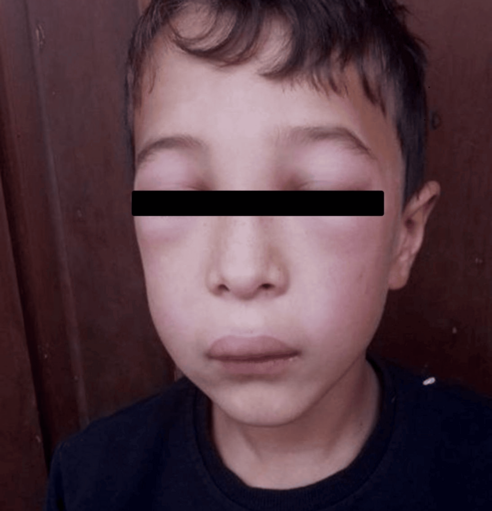 Multidimensional Assessment of Laryngeal Risk and Quality-of-Life Impairment in Pediatric Hereditary Angioedema: A Case Report