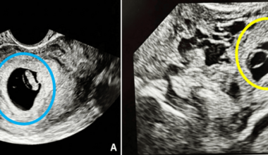 Laparoscopic Management of Spontaneous Heterotopic Pregnancy With Preservation of Intrauterine Pregnancy