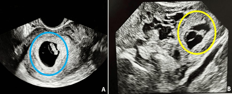 Laparoscopic Management of Spontaneous Heterotopic Pregnancy With Preservation of Intrauterine Pregnancy