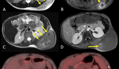 A Case Report of Preoperative Stereotactic Body Radiotherapy as Part of Multimodal Treatment in Pediatric Extraskeletal Ewing Sarcoma: An Innovative Treatment Strategy