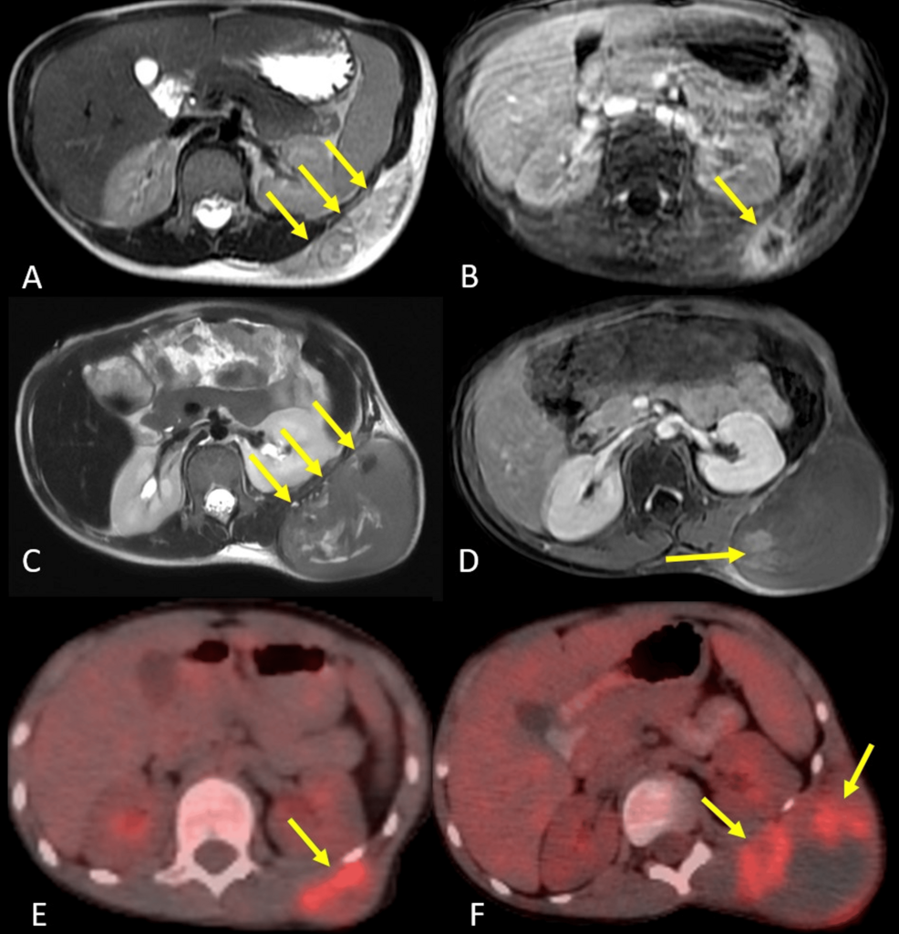 A Case Report of Preoperative Stereotactic Body Radiotherapy as Part of Multimodal Treatment in Pediatric Extraskeletal Ewing Sarcoma: An Innovative Treatment Strategy