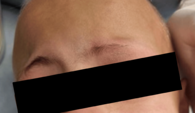 Dental Rehabilitation of a Child Diagnosed With Alopecia Areata Totalis: A Case Report