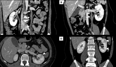 A Case of Non-obstetric Ovarian Vein Thrombosis Associated With Acute Pyelonephritis Presenting to the Emergency Department