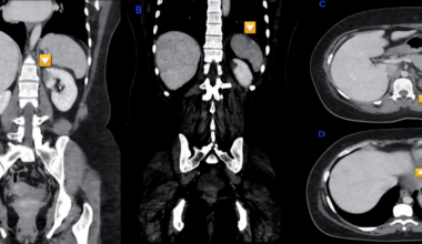 Renal and Splenic Infarctions: Unmasking Rheumatic Mitral Valve Disease in a Young Adult