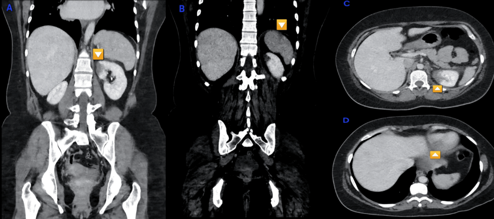 Renal and Splenic Infarctions: Unmasking Rheumatic Mitral Valve Disease in a Young Adult
