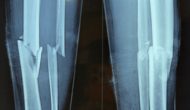 Successful Management of a Gustilo-Anderson Type I Open Comminuted Tibial Fracture Using Ilizarov Circular External Fixation: A Case Report