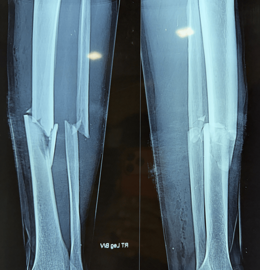 Successful Management of a Gustilo-Anderson Type I Open Comminuted Tibial Fracture Using Ilizarov Circular External Fixation: A Case Report