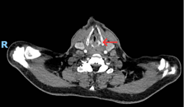 Acute Upper Airway Obstruction Induced by Nasogastric Tube Syndrome During the Management of a Bowel Obstruction