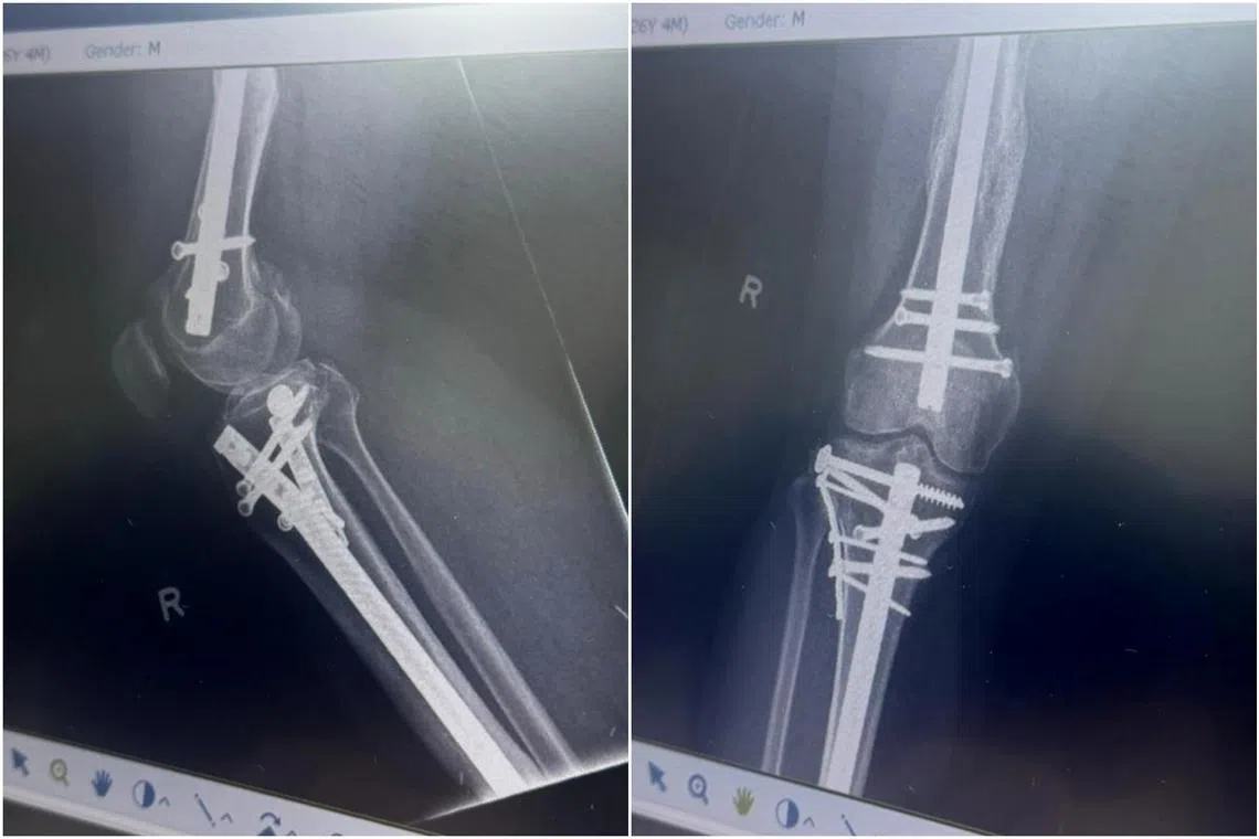 X-rays showing injuries and metal screws in Mr Mahmud’s right leg after he was crushed between two cars in the December 2021 accident.