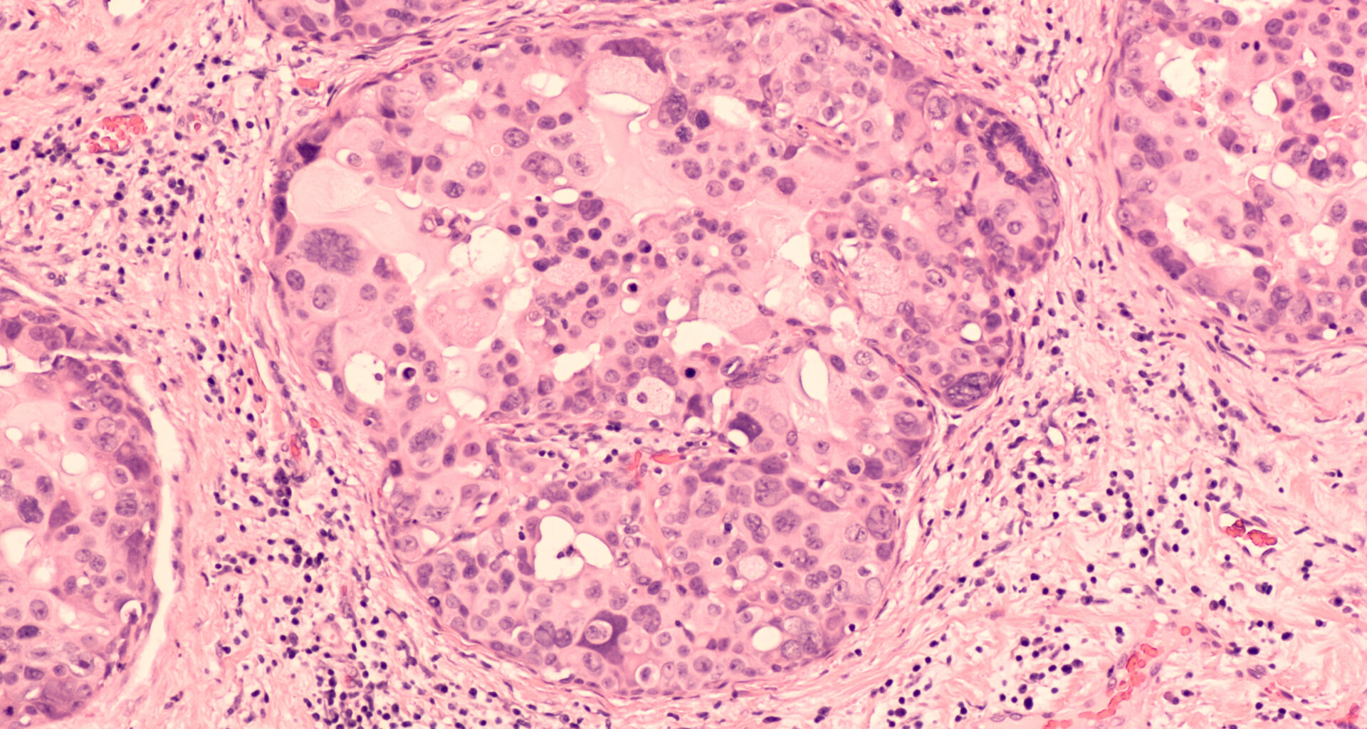 Early Results From a Trial of Active Surveillance for Low-Risk DCIS Are Reassuring Say Researchers