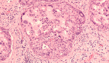 Early Results From a Trial of Active Surveillance for Low-Risk DCIS Are Reassuring Say Researchers