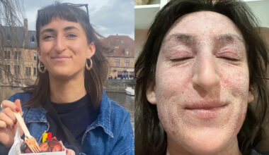 Woman ‘left bedbound and unrecognisable with oozing, elephant-like skin’ after 28 years of steroid cream use for eczema