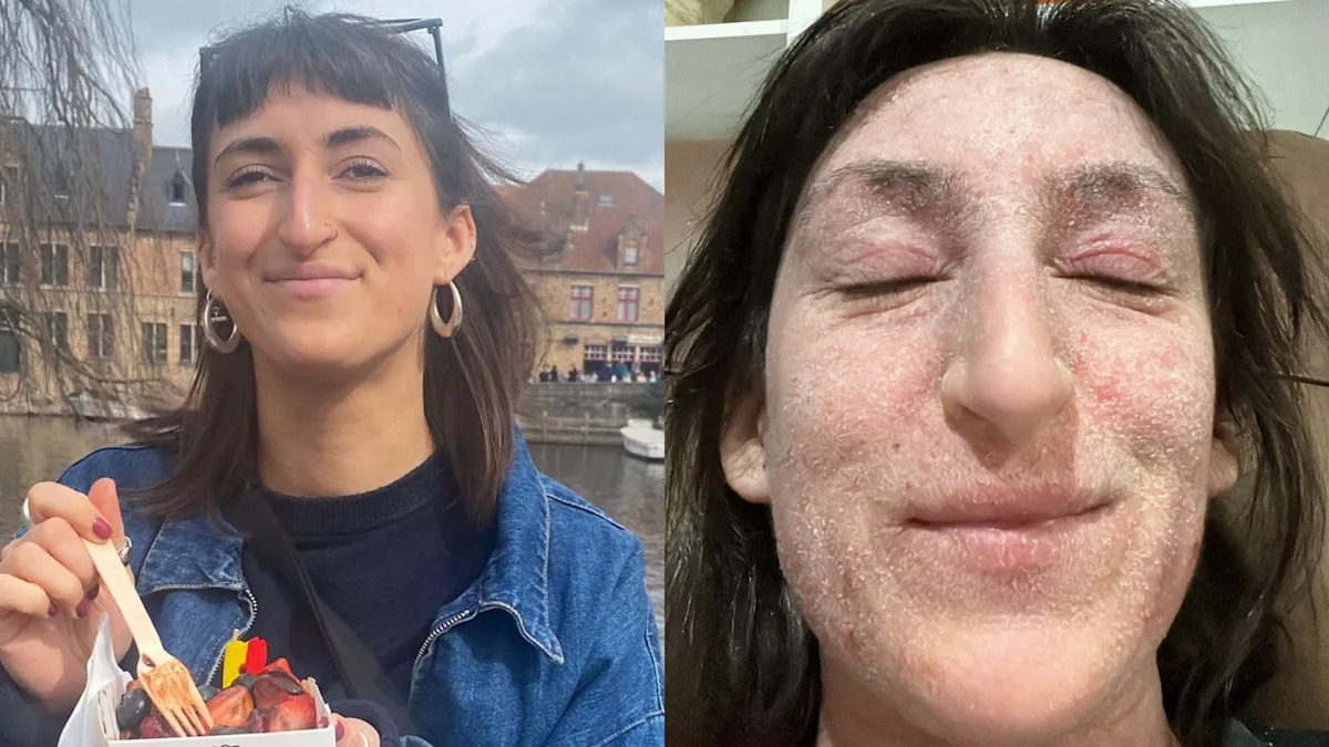Woman ‘left bedbound and unrecognisable with oozing, elephant-like skin’ after 28 years of steroid cream use for eczema