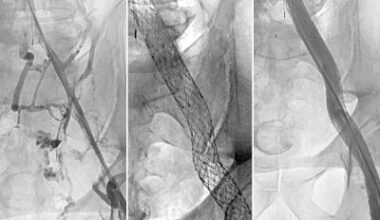 Simple stent procedure can treat post-thrombotic syndrome • healthcare-in-europe.com