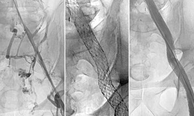 Simple stent procedure can treat post-thrombotic syndrome • healthcare-in-europe.com