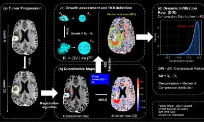 New biomarker helps assess glioblastoma aggressiveness • healthcare-in-europe.com