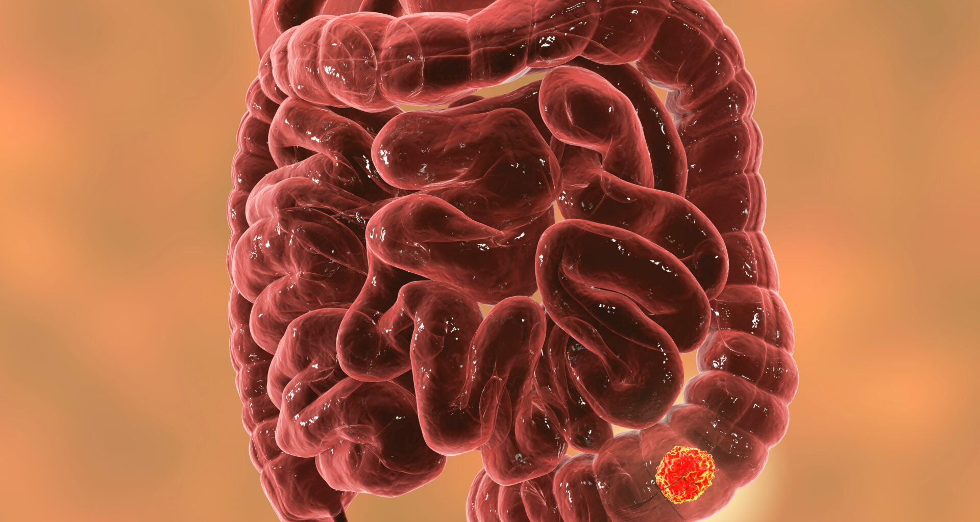 Colorectal Cancer Duloxetine Not Effective in Preventing Oxaliplatin-Induced Peripheral Neuropathy