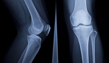 An X-ray image of a human knee, showing it from the side in an image on the left and straight on in an image on the right.