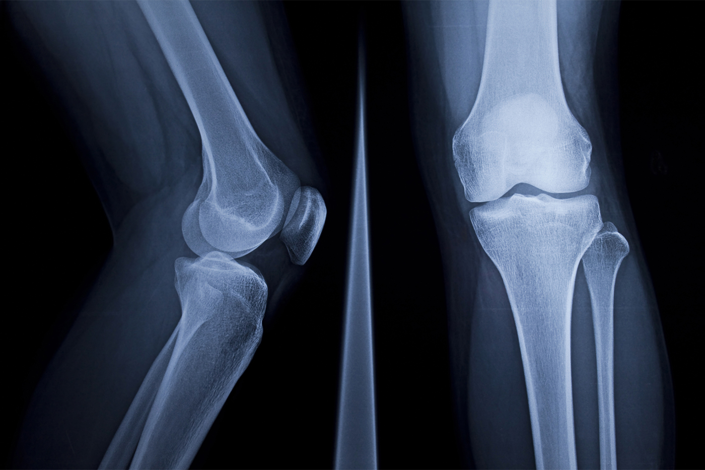 An X-ray image of a human knee, showing it from the side in an image on the left and straight on in an image on the right.