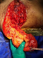 Intraoperative image from a case report of Cutibacterium avidum in post-mastectomy breast with prior silicone injections, Singapore. Image taken during an ongoing right breast reduction, depicting multiple loculations of foreign body embedded in the breast tissue.