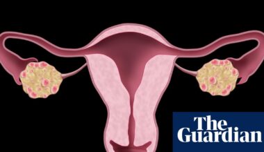 NHS urged to update website after renaming polycystic ovary syndrome | NHS