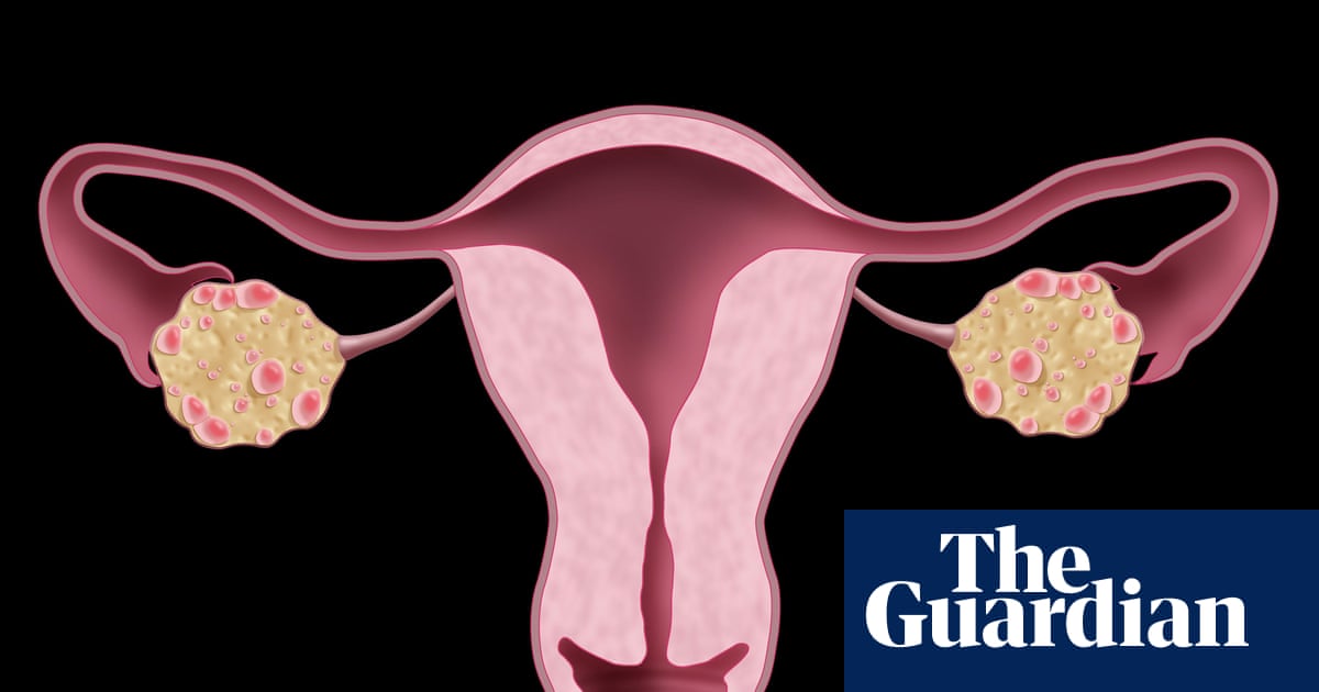 NHS urged to update website after renaming polycystic ovary syndrome | NHS