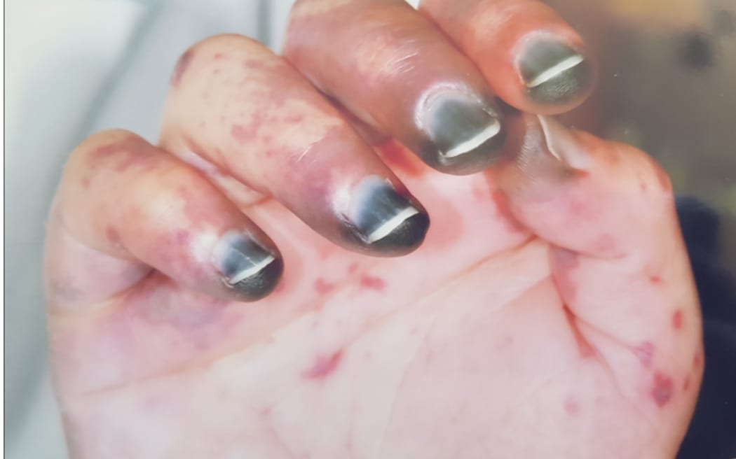 Penny Taylor was 36 when she woke up with a suspected vomiting - it turned out to be meningococcal septicaemia