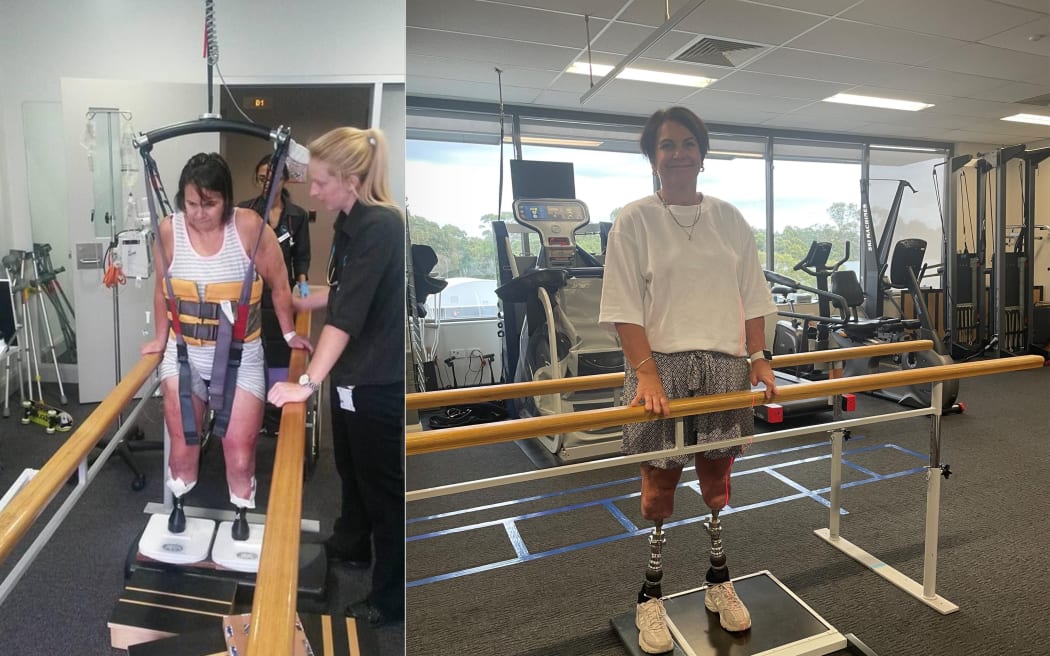 Penny Taylor after osteo-integration surgery in Australia. She's pushing for better aftercare for meningococcal survivors in New Zealand.